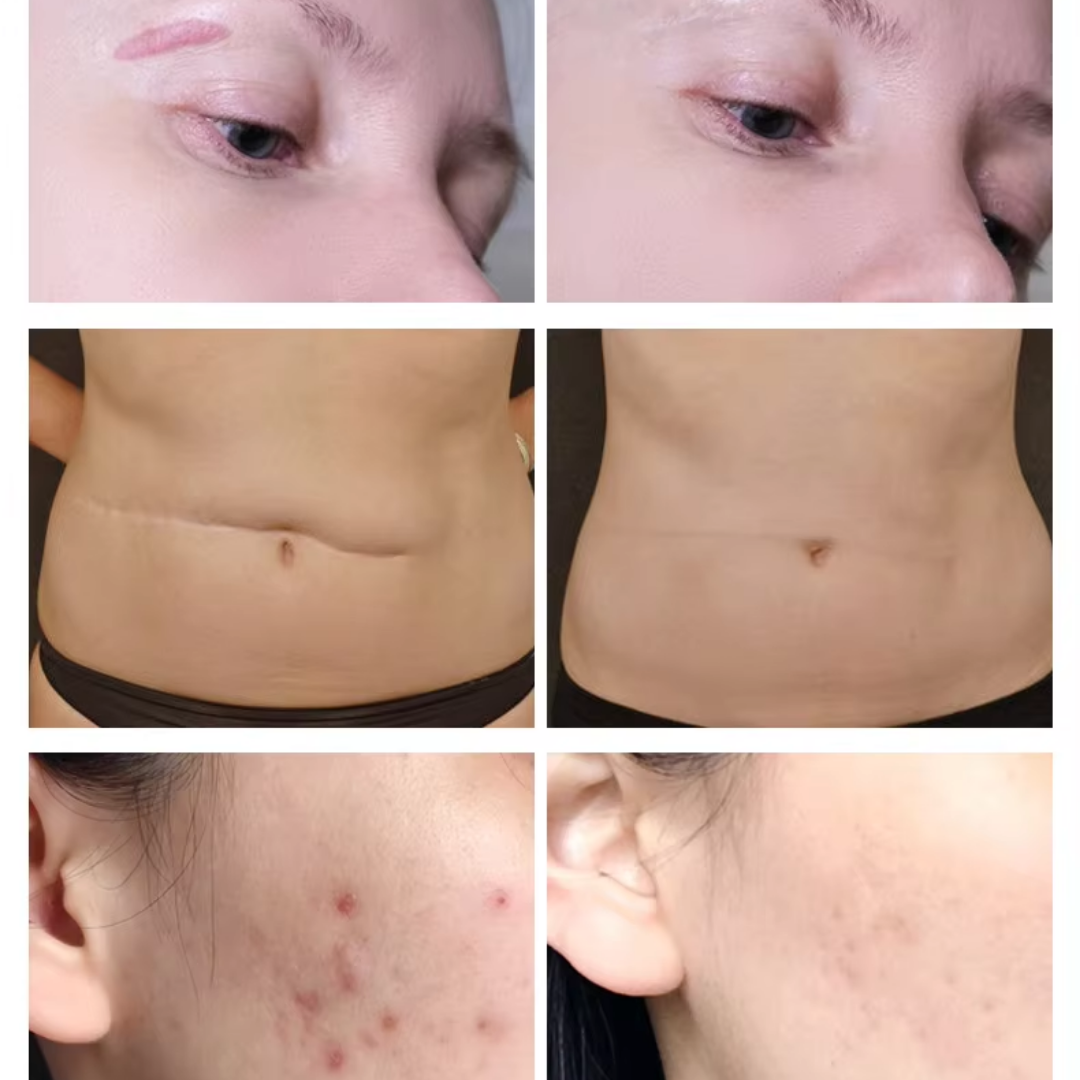 Gel restaurador de Colágeno para cicatrices y estrias