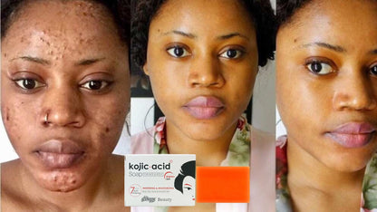 Jabón Blanqueador Exfoliante de Ácido Kójico